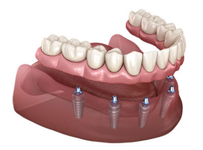 Fixed/Non Removable Teeth on Implants - Denis Robichaud Denture